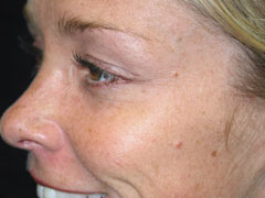 after BOTOX®