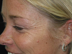 before BOTOX®