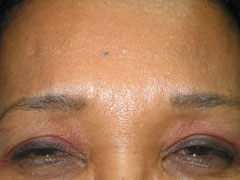 after BOTOX®