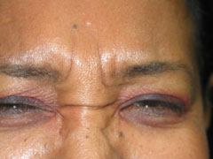 before BOTOX®