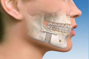 Different Types of Jaw Fractures & Their Treatments