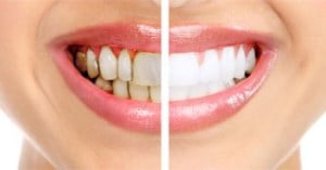 dental-implants-improved-oral-health