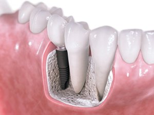 dental-implant-section