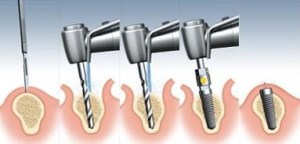 Dental Implant Surgery