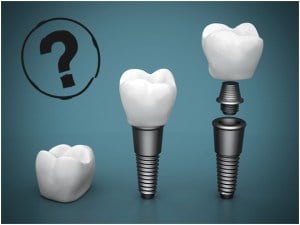 dental-implants-single