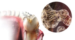 health-problems-related-to-periodontal-disease