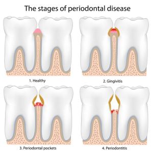 stages-of-periodontal-disease-gun-disease