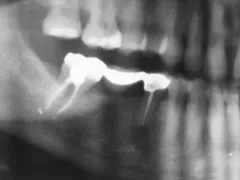 After Apicoectomy