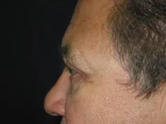 After Blepharoplasty, Midface Lift