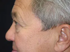 Before Blepharoplasty, Midface Lift