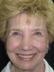 After Blepharoplasty, Midface Lift