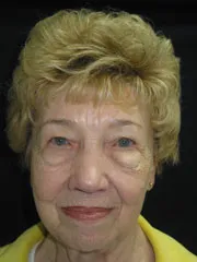 Before Blepharoplasty, Midface Lift