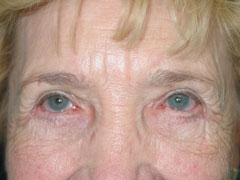 After Blepharoplasty, Midface Lift
