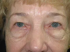 Before Blepharoplasty, Midface Lift