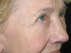 After Blepharoplasty, Midface Lift