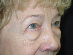 Before Blepharoplasty, Midface Lift
