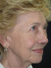 After Blepharoplasty, Midface Lift
