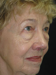 Before Blepharoplasty, Midface Lift
