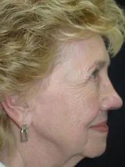 After Blepharoplasty, Midface Lift