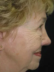 Before Blepharoplasty, Midface Lift