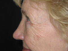 After Blepharoplasty, Midface Lift