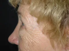 Before Blepharoplasty, Midface Lift