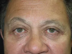 After Blepharoplasty, Midface Lift