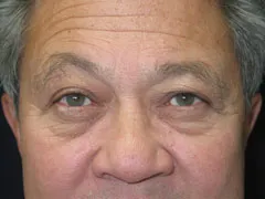 Before Blepharoplasty, Midface Lift