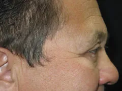 After Blepharoplasty, Midface Lift