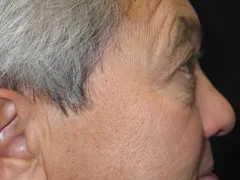 Before Blepharoplasty, Midface Lift