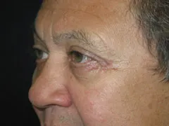 After Blepharoplasty, Midface Lift