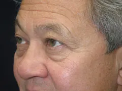 Before Blepharoplasty, Midface Lift