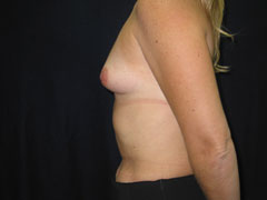 Before Breast Augmentation