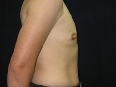 Before Breast Augmentation