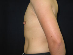 Before Breast Augmentation