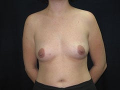 Before Breast Augmentation