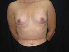 Before Breast Augmentation