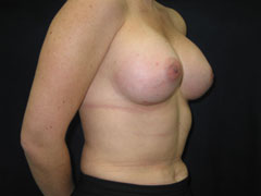 After Breast Augmentation