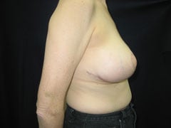 After Breast Lift