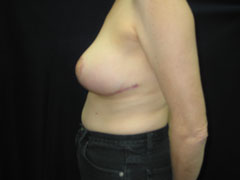 After Breast Lift