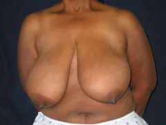 Before Breast Reduction