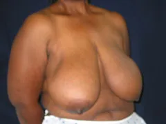 Before Breast Reduction