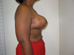 After Breast Reduction