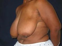 Before Breast Reduction
