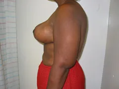 After Breast Reduction