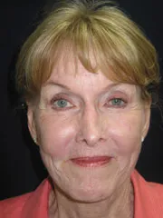 After Browlift, Blepharoplasty, Rhinoplasty, Face and Neck lift, Fat Augmentation, Laser Resurfacing