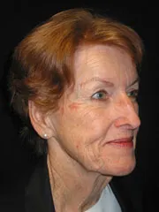 Before Browlift, Blepharoplasty, Rhinoplasty, Face and Neck lift, Fat Augmentation, Laser Resurfacing