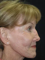 After Browlift, Blepharoplasty, Rhinoplasty, Face and Neck lift, Fat Augmentation, Laser Resurfacing