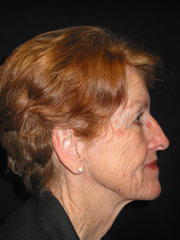 Before Browlift, Blepharoplasty, Rhinoplasty, Face and Neck lift, Fat Augmentation, Laser Resurfacing