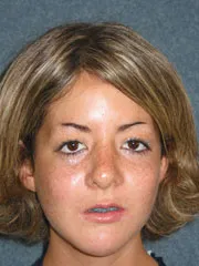 After Cheek Implants, Rhinoplasty, Mandibular Advancement, Genioplasty